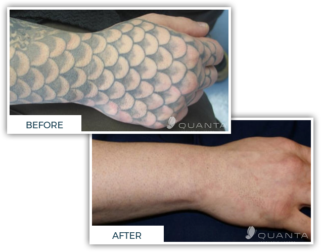 Laser Tattoo Removal Before & After Photos - Novi & Troy, MI